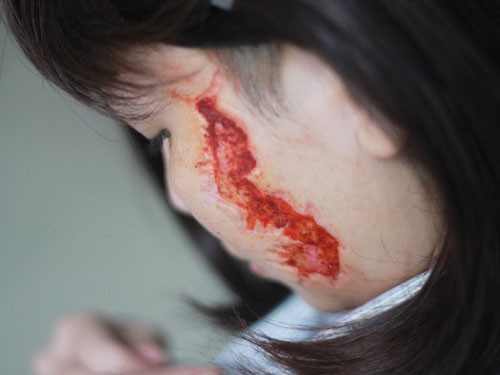 Cô gái bị xăm "quái vật" lên mặt: Vết xăm biến thành sẹo lõm ảnh 1